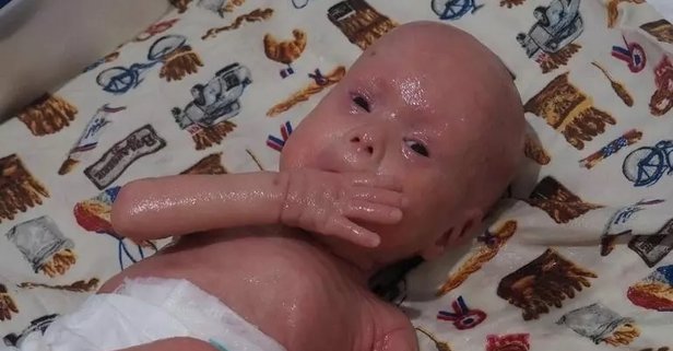 Uşak'ta Deri Hastalığıyla Dünyaya Gelen Bebeğin Babasının Açtığı Soybağı Davası Reddedildi